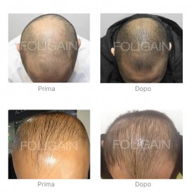 Foligain F5 Minoxidil 5% Uomo 60ml